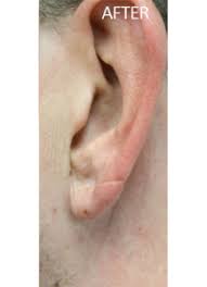 torn earlobe repair before and after