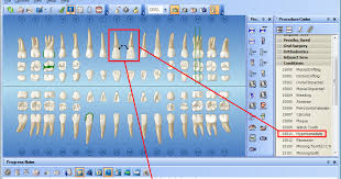 Dentrix Tip Tuesdays Charting Conditions Using Condition Codes