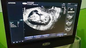 Beberapa perkembangan organ pada janin tersebut. Usia Janin 3 Bulan Atau 12 Minggu Usg Bergerak Gerak Youtube