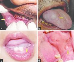 mucocele involving lower lip
