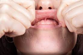 frenectomy why it s needed and when