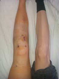 Slikovni rezultat za operacija noge