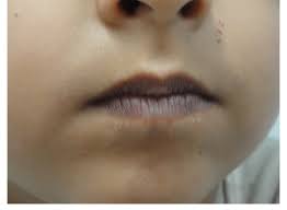 increased pigmentation over lips
