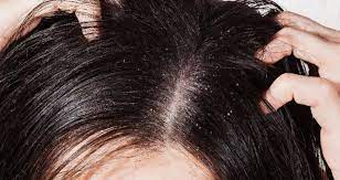Hair Care Tips: डैंड्रफ की परेशानी होगी जड़ से खत्म, अपनाएं ये 5 आसान घरेलू  नुस्खे