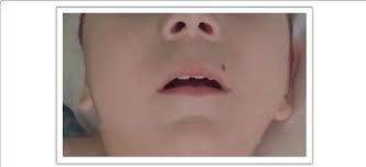 long philtrum small mouth thin lips