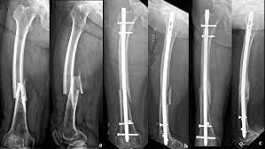 atypical fem shaft fracture