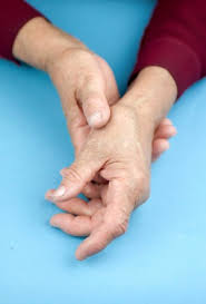Image result for rheumatoid arthritis images