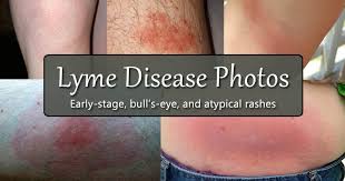 lyme disease rash photos early se