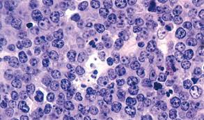 Whats The Difference Between Hodgkin And Non Hodgkin Lymphoma