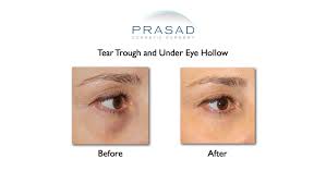 under eye filler for hollow eyes tear