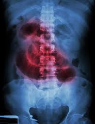 bowel obstruction intestinal