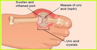 Gout Diet To Lower Uric Acid With Diet Chart And Food To Eat