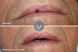 lip vein venous lake treatment the