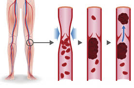 The development of a blood clot in your leg is also known as deep vein thrombosis (dvt). Blood Clot Behind Knee Symptoms Causes And Treatment