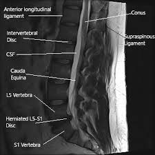 surgical treatment of sciatica of