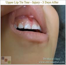 upper lip tie tear injury
