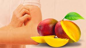 suffering from mango allergy know that