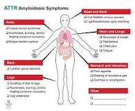 Image result for icd 10 code for attr cardiac amyloidosis
