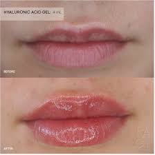 needleless lip filler what it is how