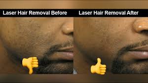 laser hair removal for men you