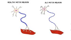 Although als is incurable and fatal, with median survival of 3 years, treatment can extend. 2 Minute Neuroscience Amyotrophic Lateral Sclerosis Als Youtube