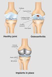 total knee replacement surgery at ssc