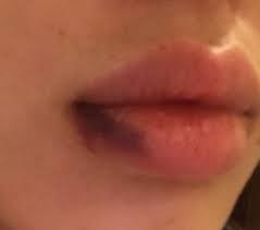 permanent bruising on lips from filler