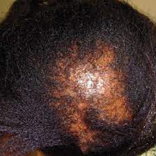 chemical hair relaxers