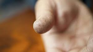 splitting fingertips skin fissures