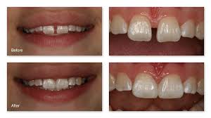 This gap teeth fix is not suitable for larger gaps, because bonding can make the teeth look too big. Closing Gaps Gallery Dr Jack M Hosner D D S