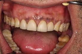 Drug-Induced Oral Mucosal Pigmentation | SpringerLink