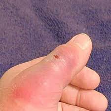 Most bites result in mild symptoms around the area of the bite. How To Identify And Treat 9 Different Bug Bites Considerable