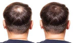 10 best ways to stop hair loss dr