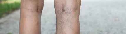 Pain in both the calf and thigh can occur with a dvt clot higher in the thigh. Deep Venous Thrombosis Blood Clot Dvt Symptoms Peoria Az