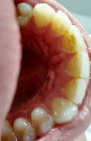 Allowing food to sit on teeth for too long invites unwanted bacteria. Tons Of Cavities And Suddenly None Dentistry