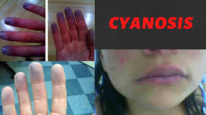 cyanosis causes symptoms types