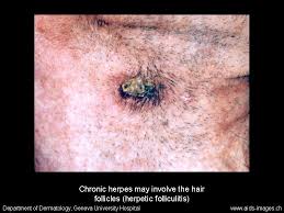 Here's how to exfoliate to get rid. Herpes Simplex Virus Hsv Varicella Zoster Virus Vzv Infectious Disease Advisor