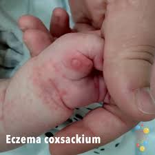 eczema sackium skin deep