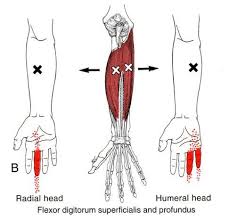 If the finger is broken, the symptoms include numbness, sharp pain as well as swelling. Image Result For Pinky Finger Trigger Point Trigger Points Trigger Point Therapy Massage Therapy