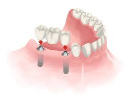 dental bridges