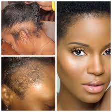 Image result for natural hair thinning hairlines