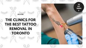clinics for the best tattoo removal