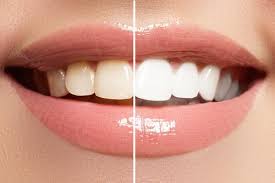 Then spread baking soda all over your gums and teeth. 6 Natural Ways To Whiten Your Teeth Pleasant Family Dentistry General Dentists