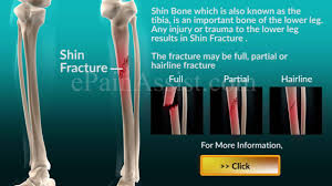 what is shin fracture tibia fracture