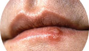 herpes hsv 1 and hsv 2 causes
