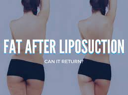 liposuction wall street cosmetic surgery
