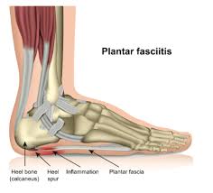 are barefoot shoes good for plantar
