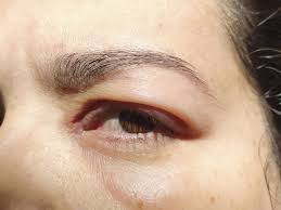 allergic conjunctivitis