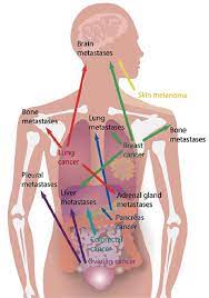 multiple sites of metastasis for