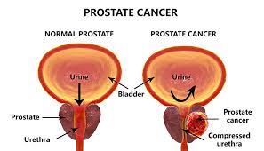 Weak or interrupted flow of urine. Prostate Cancer Symptoms Causes Treatment Apollo Spectra